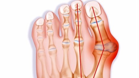 Behandlung von hallux valgus